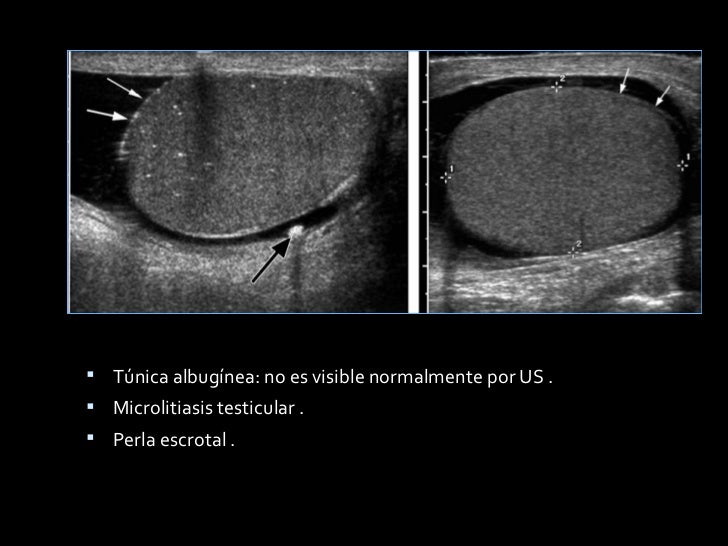 Se Puede Hacer El Laser En Los Testiculos CALCIFICACION TESTICULAR PDF